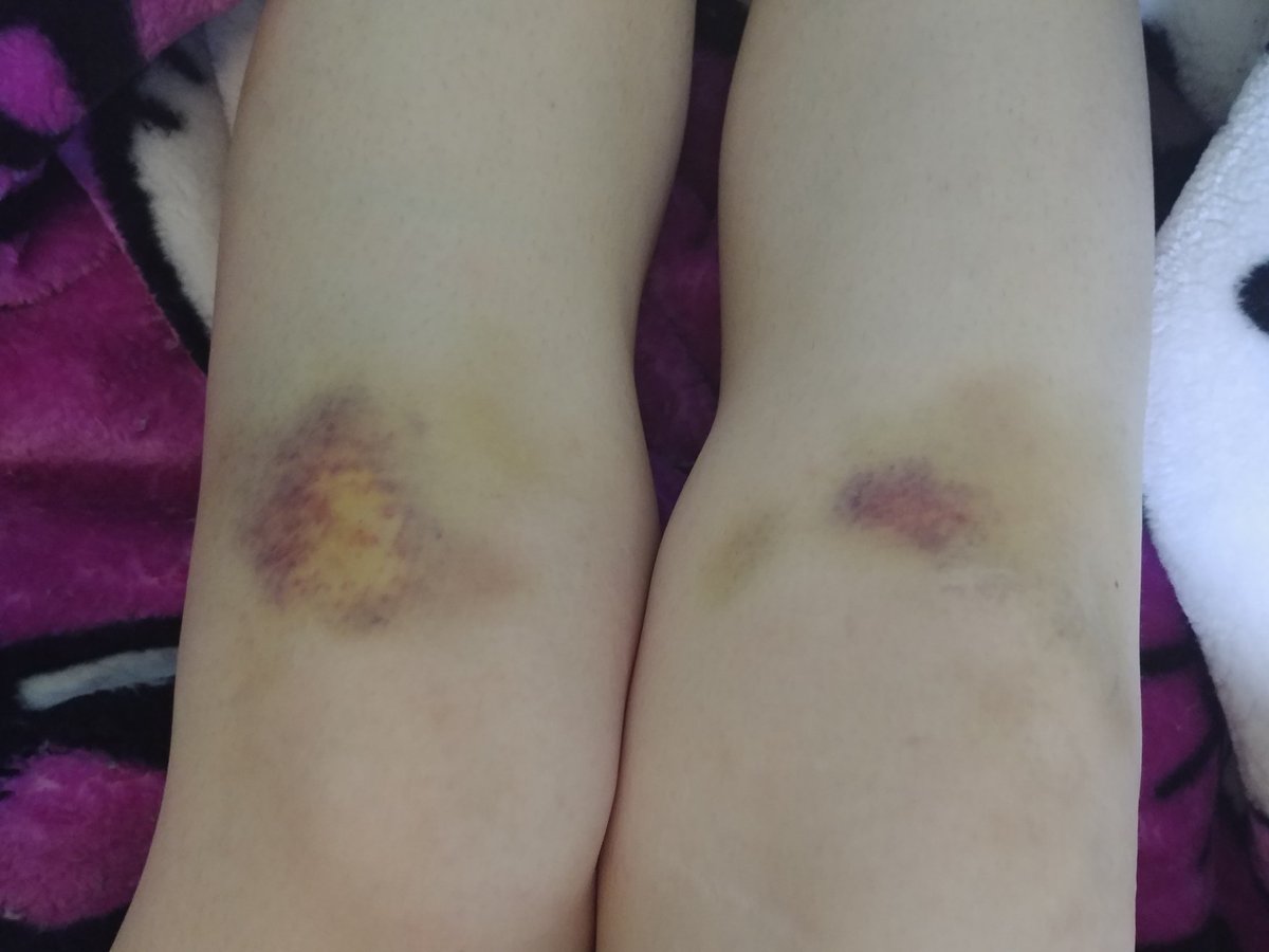 Bruised legs